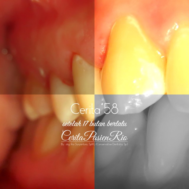 ceritapasien rio new premolar.001