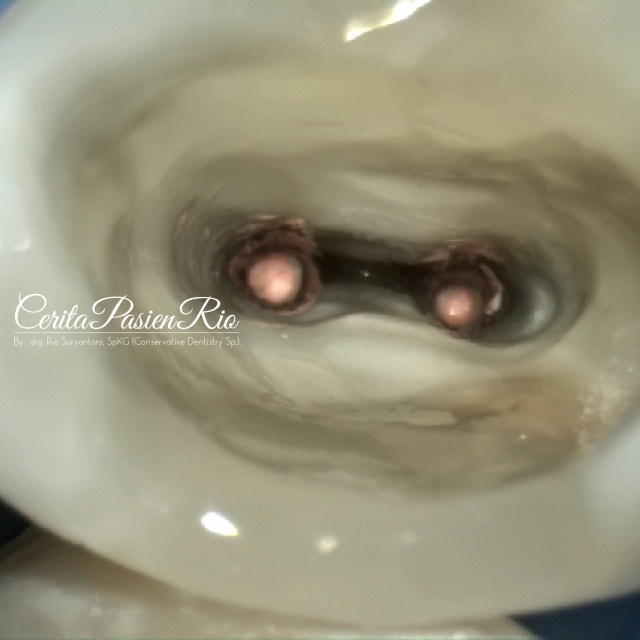 gambar 12. pengisian saluran akar.