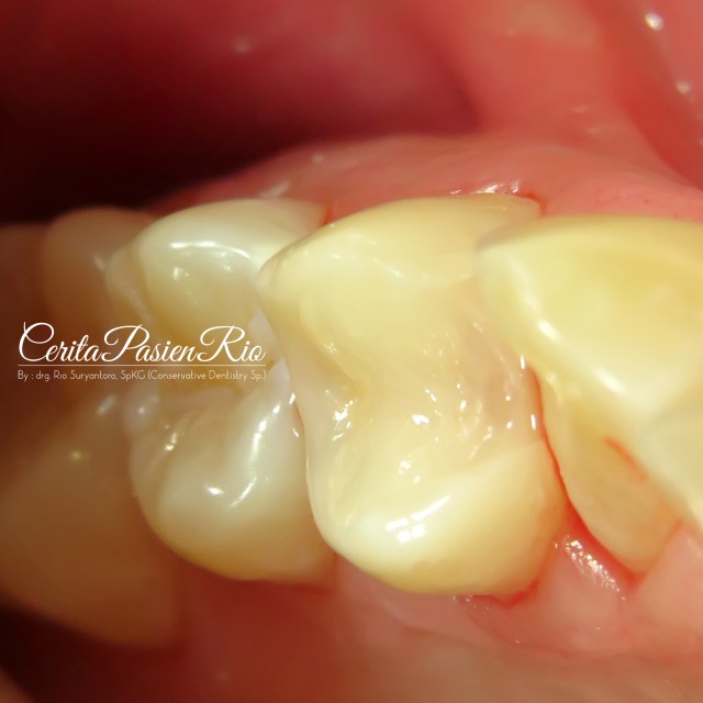 gambar . setelah pemolesan, cek oklusi dan artikulasi.