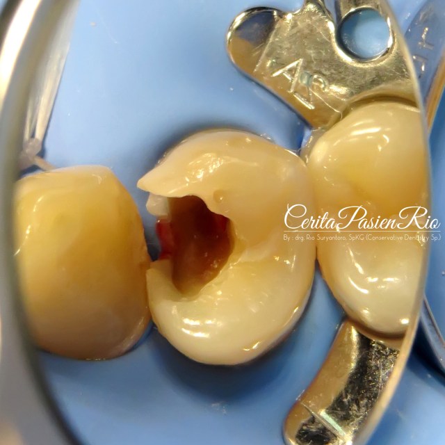 dokter gigi rio spesialis konservasi terbaik jakarta perawatan saluran akar tambalan resin komposit 2