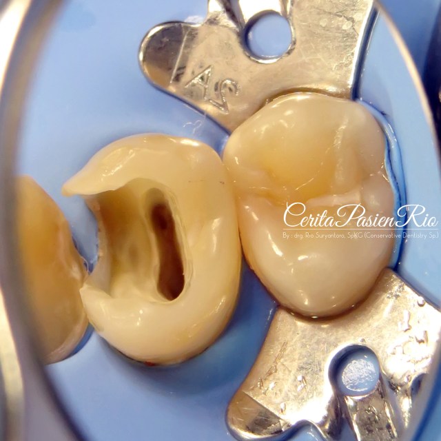 gambar 5. preparasi akses dalam perawatan saluran akar.