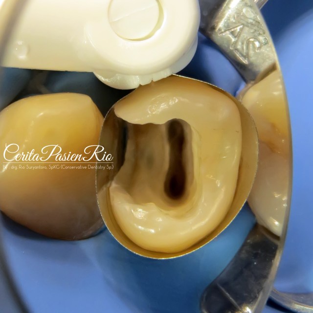 gambar 6. pemasangan matriks sebelum peletakan resin komposit.