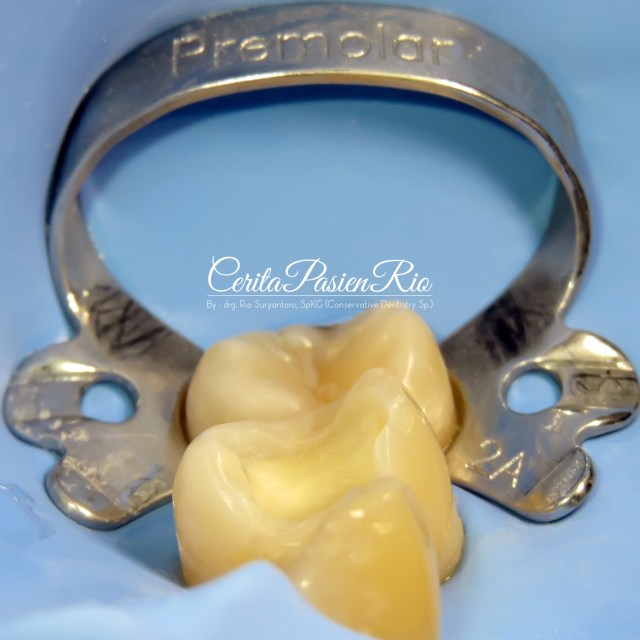 gambar . Keadaan tambalan dilihat dari sisi mesial