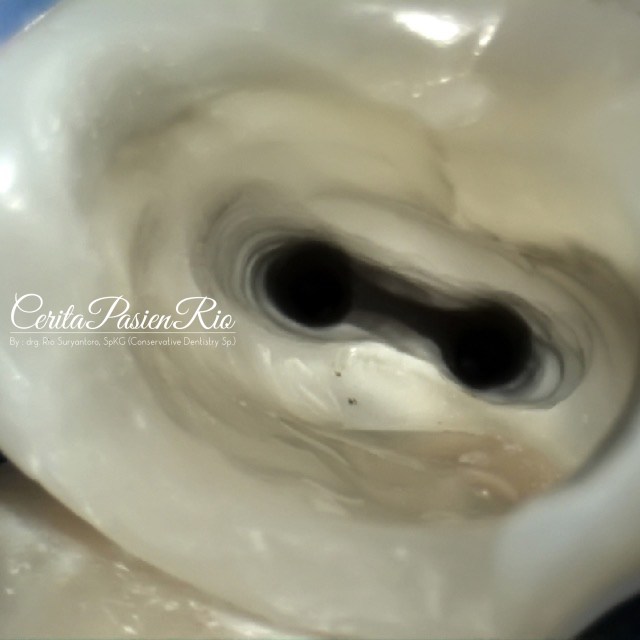 gambar 9. Preparasi saluran akar menggunakan protaper next (dentsply sirona)