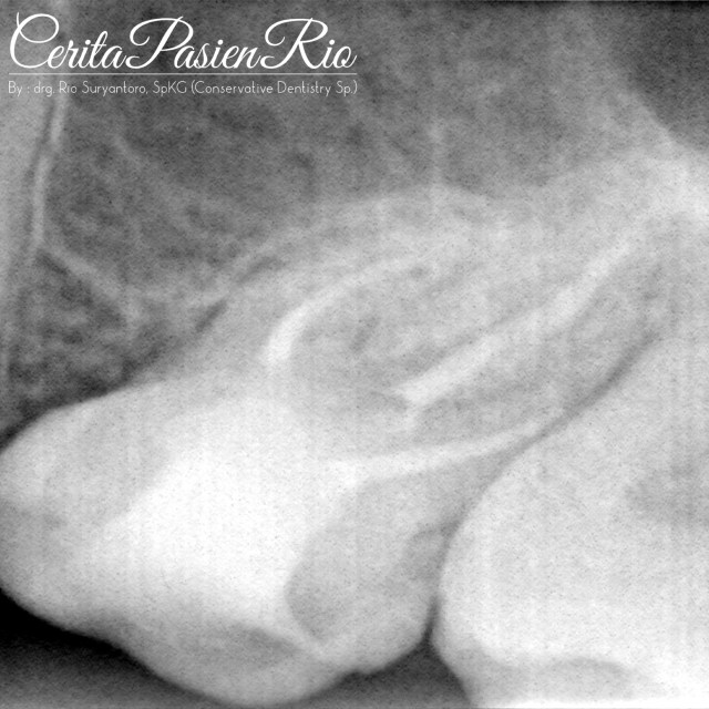 gambar 12. foto Xray (VistaRay 7.1 (Durr) 60KV, 3mA, 0,03 second) pasca pengisian saluran akar