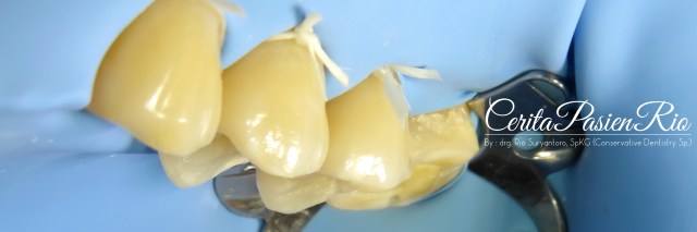 gambar 14. keadaan sebelum dilakukan prosedur restorasi. saya memasang rubber dam pada beberapa gigi.