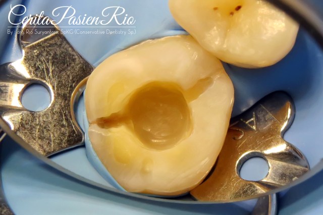 gambar 15. semua jaringan gigi yang crack saya preparasi, untuk selanjutnya diisi dengan resin komposit.