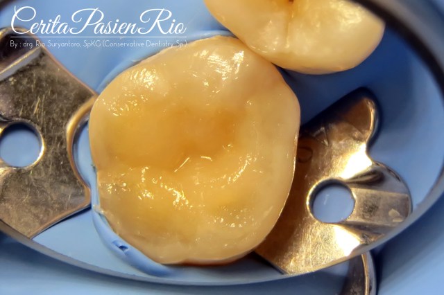 gambar 16. peletakan resin komposit packable (G-aenial dari GC)