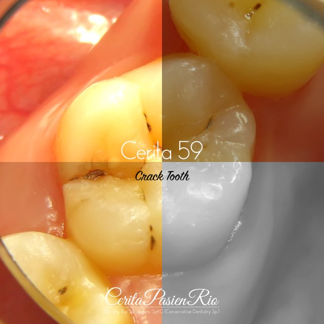 dokter gigi spesialis konservasi gigi terbaik di jakarta indonesia perawatan saluran akar tambalan resin komposit 17