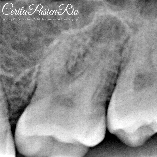 dokter gigi spesialis konservasi gigi terbaik di jakarta indonesia perawatan saluran akar tambalan resin komposit 2