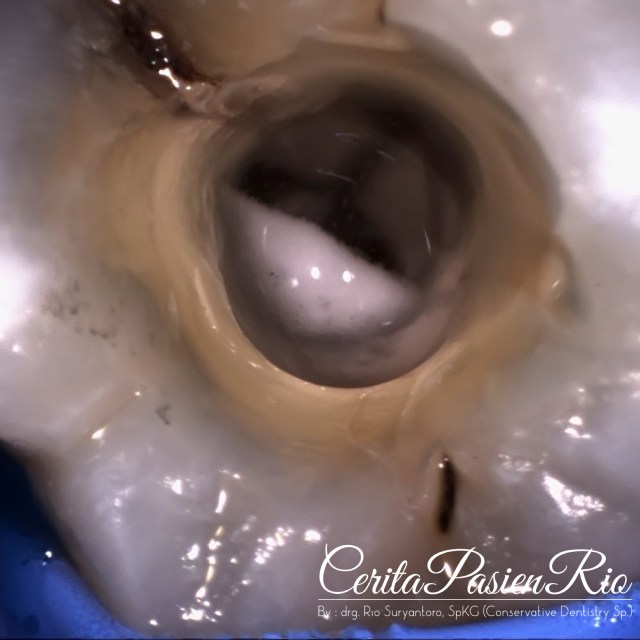 gambar 7. irrigasi di dalam saluran akar. tampak bubbling.