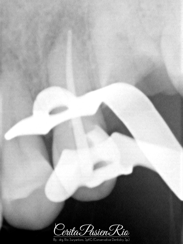 gambar 9. foto kon utama pada gigi 25.