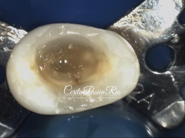 gambar 11. coronal seal pasca pengisian saluran akar.
