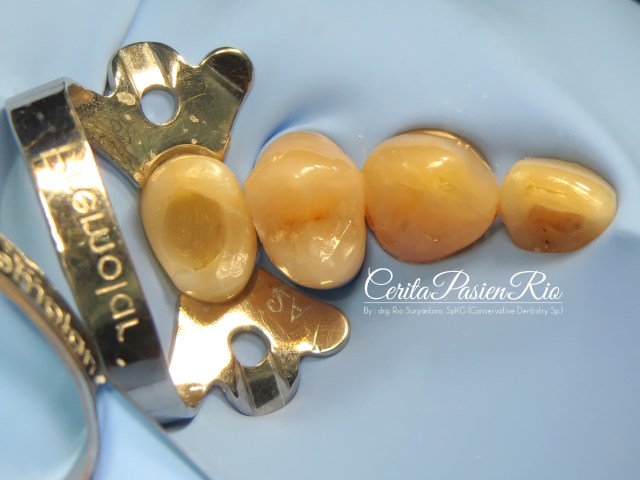 gambar 14. saya menggunakan fiber reinforced composite resin (everX posterior) sebagai dentin replacement.