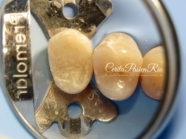 gambar 15. saya menggunakan GC G-aenial sebagai top/coronal layer.