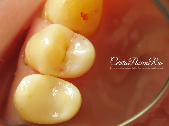 gambar 17. hasil akhir perawatan restorasi pada gigi 25. single shade, tanpa color modifier. (G-aenial - GC)