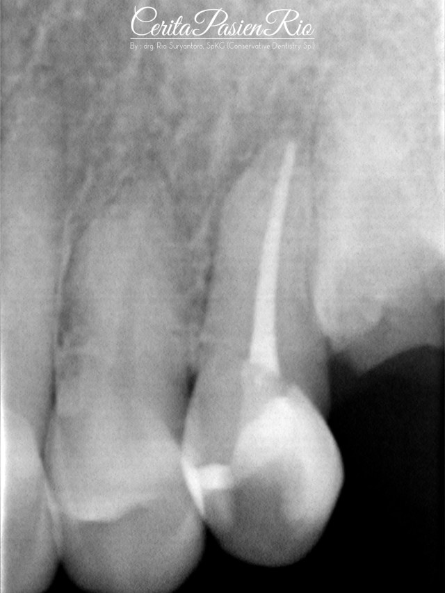 gambar 18. foto rontgent evaluasi perawatan. tampak restorasi yang homogen, marginal integriti yang baik. 