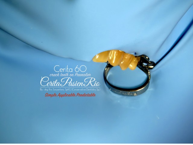 spesialis konservasi gigi perawatan saluran akar tambalan komposit resin estetik 19