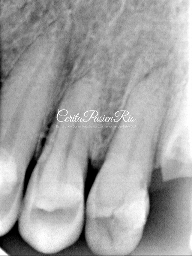 gambar 2. xray pasien saat pertama kali datang.