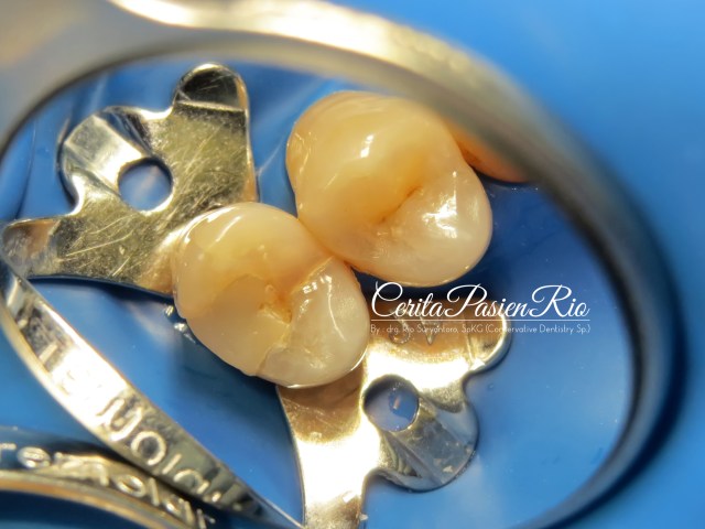 gambar 3. pemasangan rubber dam (sanctuary rubber dan clamp, dengan cerkamed rubber dam sheet)