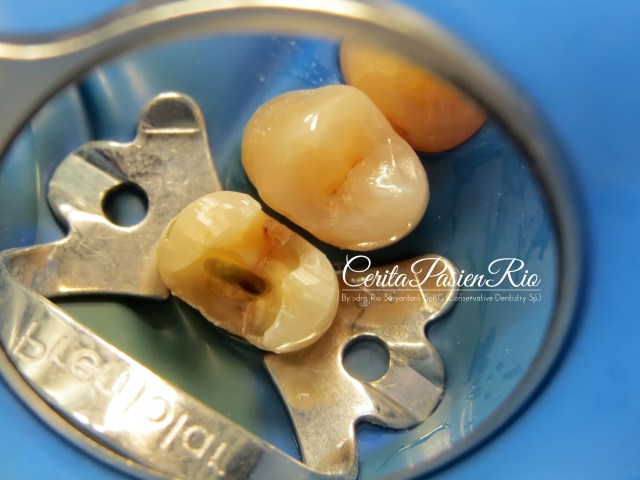 gambar 4. pembuangan jarigan karies dan tambalan lama yang bocor, sehingga didapatkan jaringan detin yang sehat.