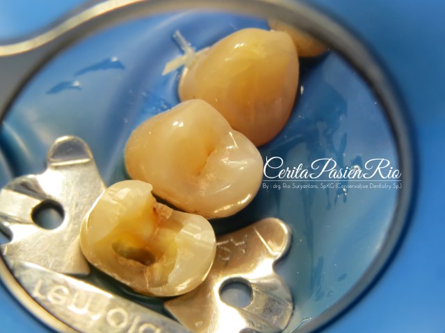 gambar 5. terlihat garis crack yang berjalan di tepi mesial, terbatas di bagian mahkota.