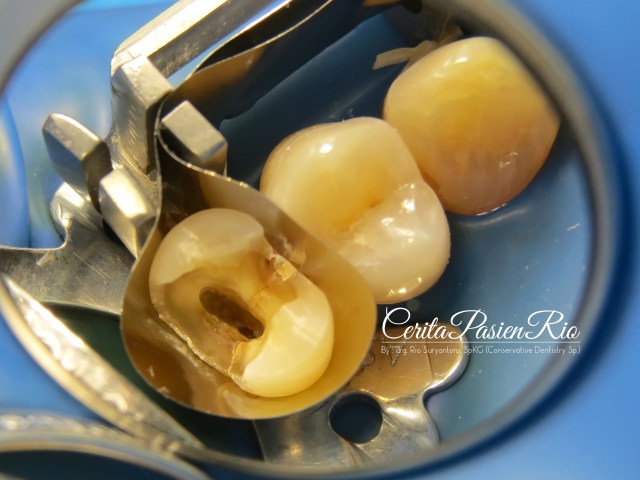 gambar 6. pembuatan dinding mesial dan distal dengan greatercurve matrix.