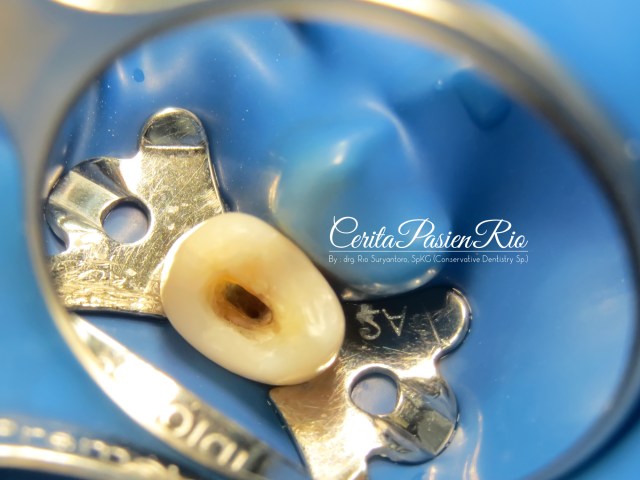 gambar 7. selesai membuat dinding mesial dan distal dengan resin komposit (Ceram-X one dari Dentsply) dipoles dengan Soflex (3M)