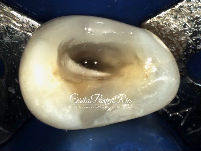 gambar 8. keadaan gigi saat cleaning and shaping. 