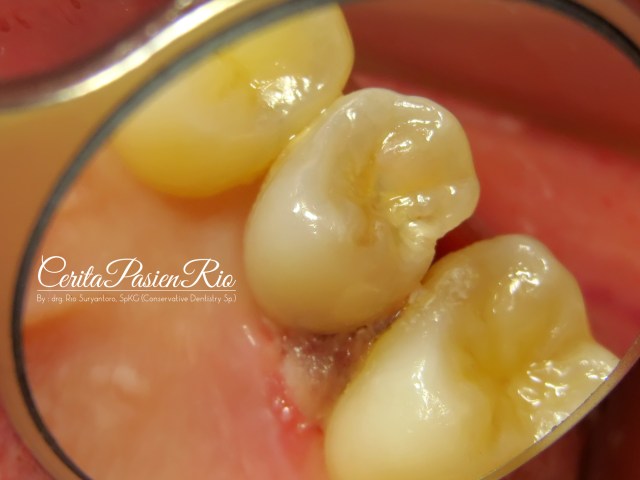 gambar 1. keadaan awal gigi dilihat dari bagian palatal. tampak ada gingiva yang berwarna putih dikelilingi oleh warna kemerahan.