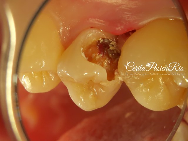 gambar 2. keadaan gigi 15 dilihat dari bukal. terlihat kavitas kelas 2, dan keadaan gusi dan tulang alveolar yang memucat.