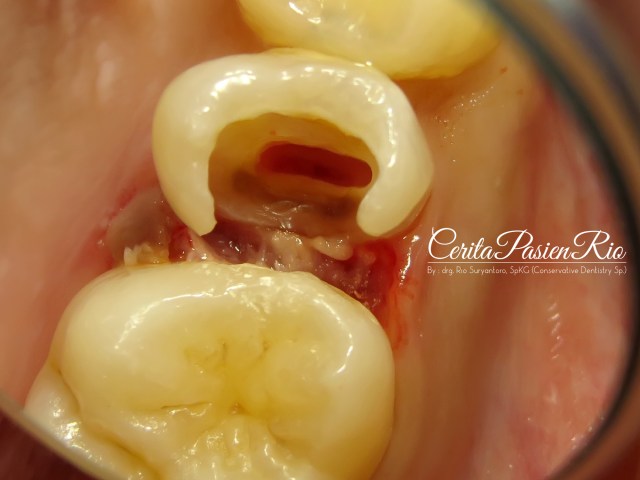 gambar 4. preparasi akses sebelum memasang rubber dam.