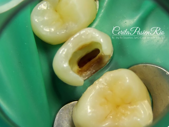 gambar 5. pemasangan rubber dam pada gigi 14,15, dan 16.