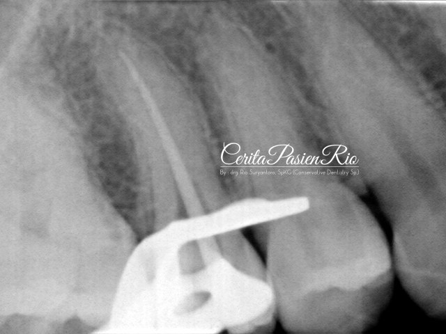 gambar 17. evaluasi kon gutta percha utama sebelum dilakukan pengisan saluran akar.