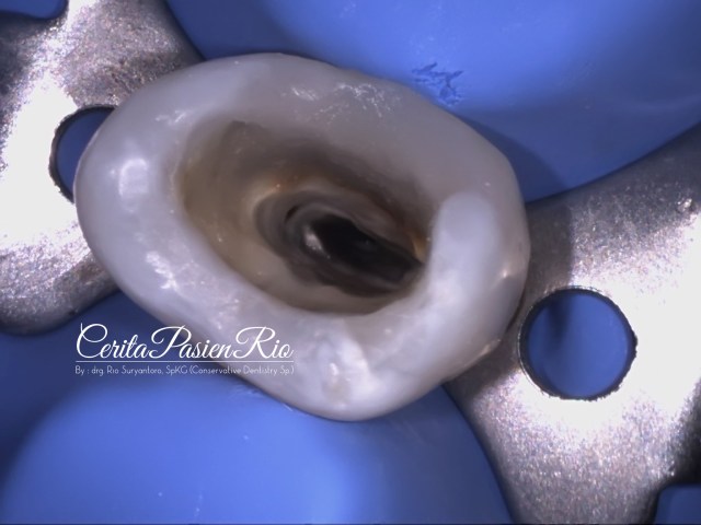 gambar 16. keadaan saluran akar pasca dilakukan preparasi biomekanis.