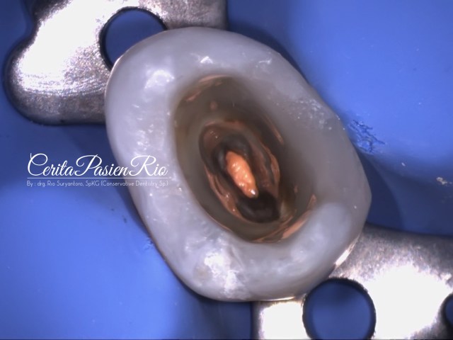 gambar 17. pengisian saluran akar selesai.