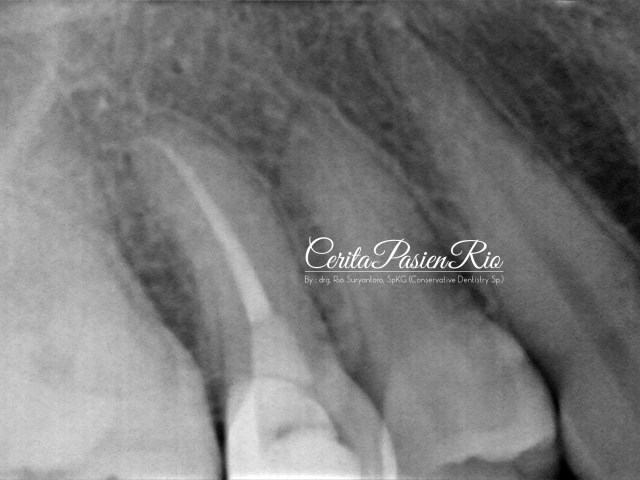 gambar 21. evaluasi radiograf pasca pengisian saluran akar. tampak integrasi tepi tambalan resin komposit kelas 2 yang baik, coronal seal yang juga beradaptasi yang baik dengan gutta percha dan gigi.
