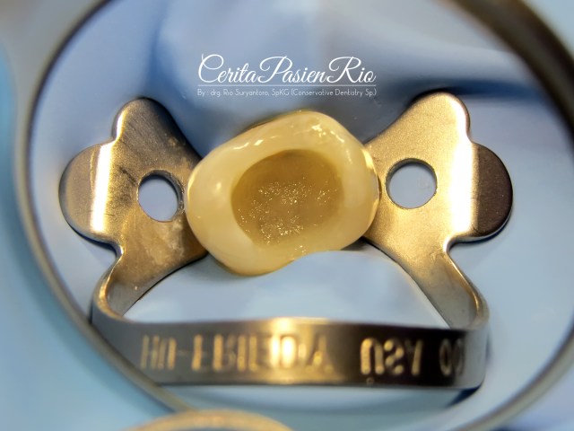 gambar 23. core build up dengan packable bulkfill composite resin (filtek bulkfill - 3M)