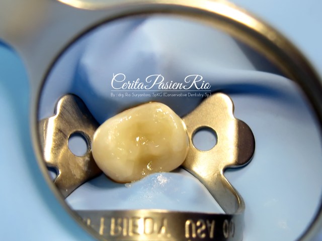 gambar 25. peletakan shading enamel sekaligus membentuk kontur oklusal dengan warna high value, Vita A2. (Filtek Z350XT - 3M)