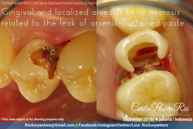 kasus ini pernah saya share juga di SekilasKonservasiGigi.Com 